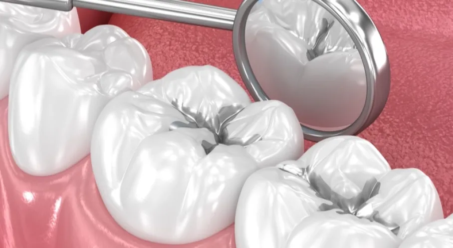 Amalgam Dolgularınızı Değiştirmeli misiniz? Bilimsel Veriler Cıva Korkusuna Son Noktayı Koydu!