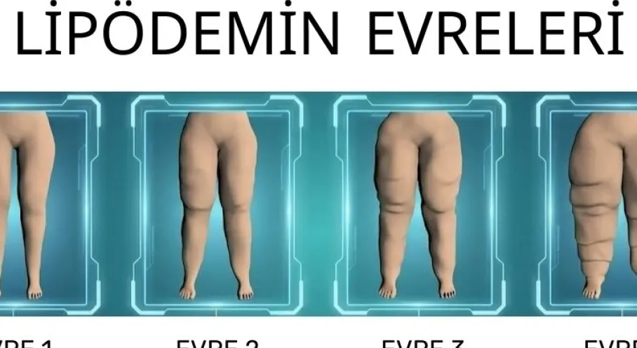 “Su İçsem Yarıyor” Diyorsanız Tehlike Çanları! Lipödem Belirtileri ve Etkili Tedavi Yöntemleri
